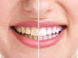 Cấp cứu hàm răng ngày càng ố vàng xấu xí Cấp cứu hàm răng ngày càng ố vàng xấu xí